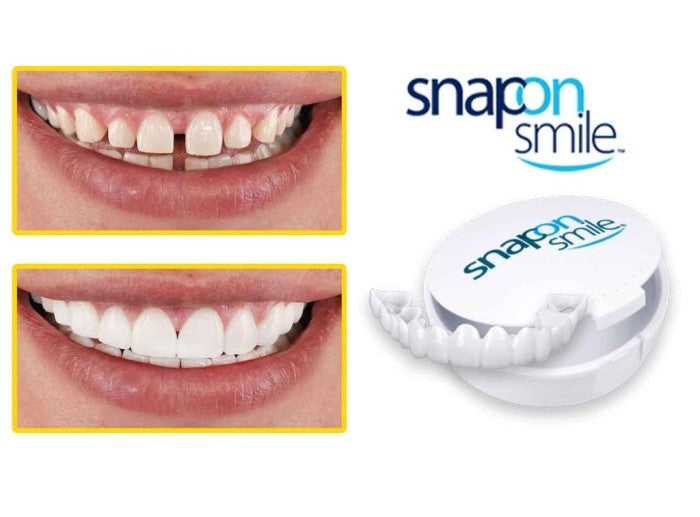 Snap on Smile : Confort et ajustement parfait