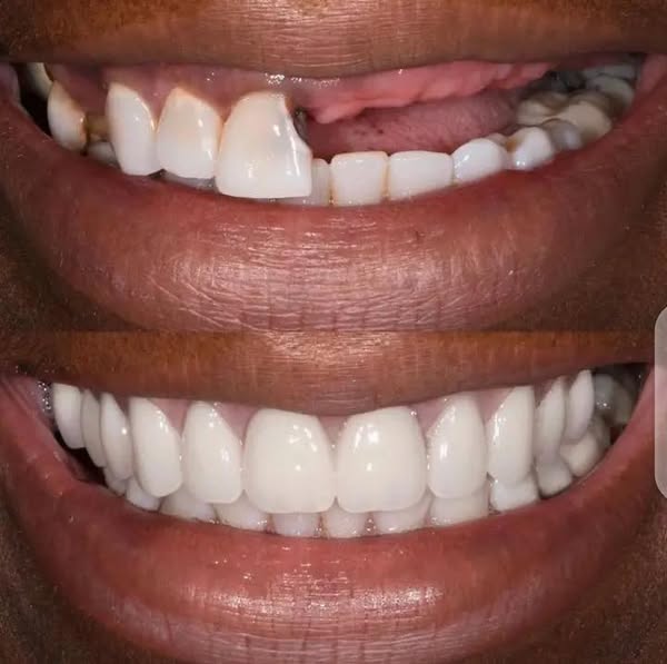 Snap on Smile : Confort et ajustement parfait